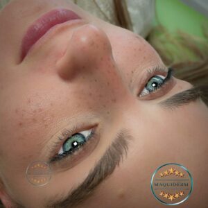 Formation taches de rousseur