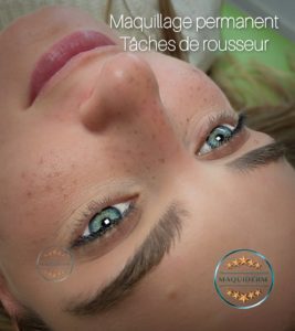 Fausses taches de rousseur