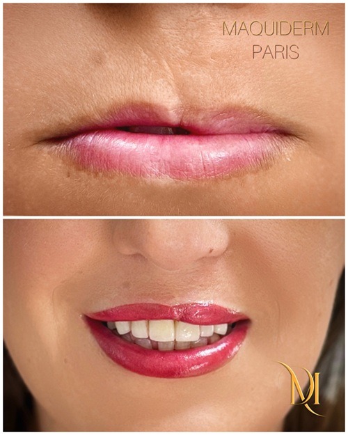 Bouche bec de lièvre