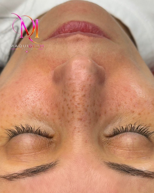 Taches de rousseur en maquillage permanent à Paris – MAQUIDERM